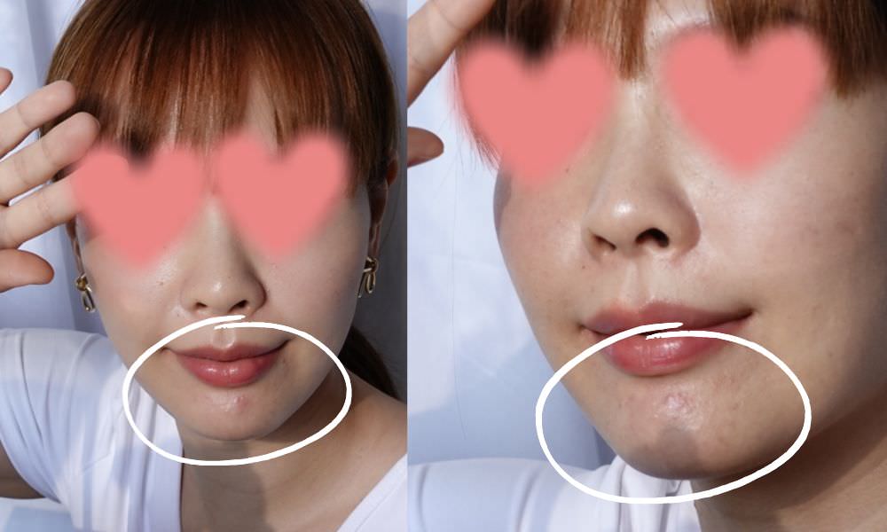 【油痘粉刺肌必看】佳思優整形醫美診所『黑鑽水飛梭』初體驗，粉刺大掃除，肌膚亮出新高度～