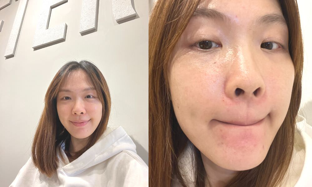 【油痘粉刺肌必看】佳思優整形醫美診所『黑鑽水飛梭』初體驗，粉刺大掃除，肌膚亮出新高度～