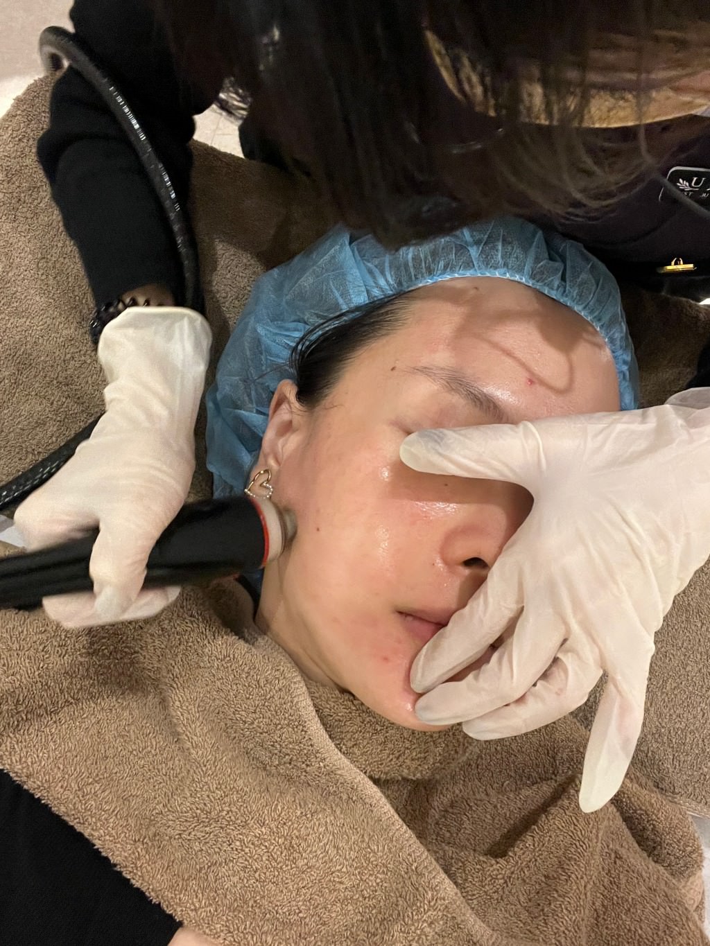 【油痘粉刺肌必看】佳思優整形醫美診所『黑鑽水飛梭』初體驗，粉刺大掃除，肌膚亮出新高度～