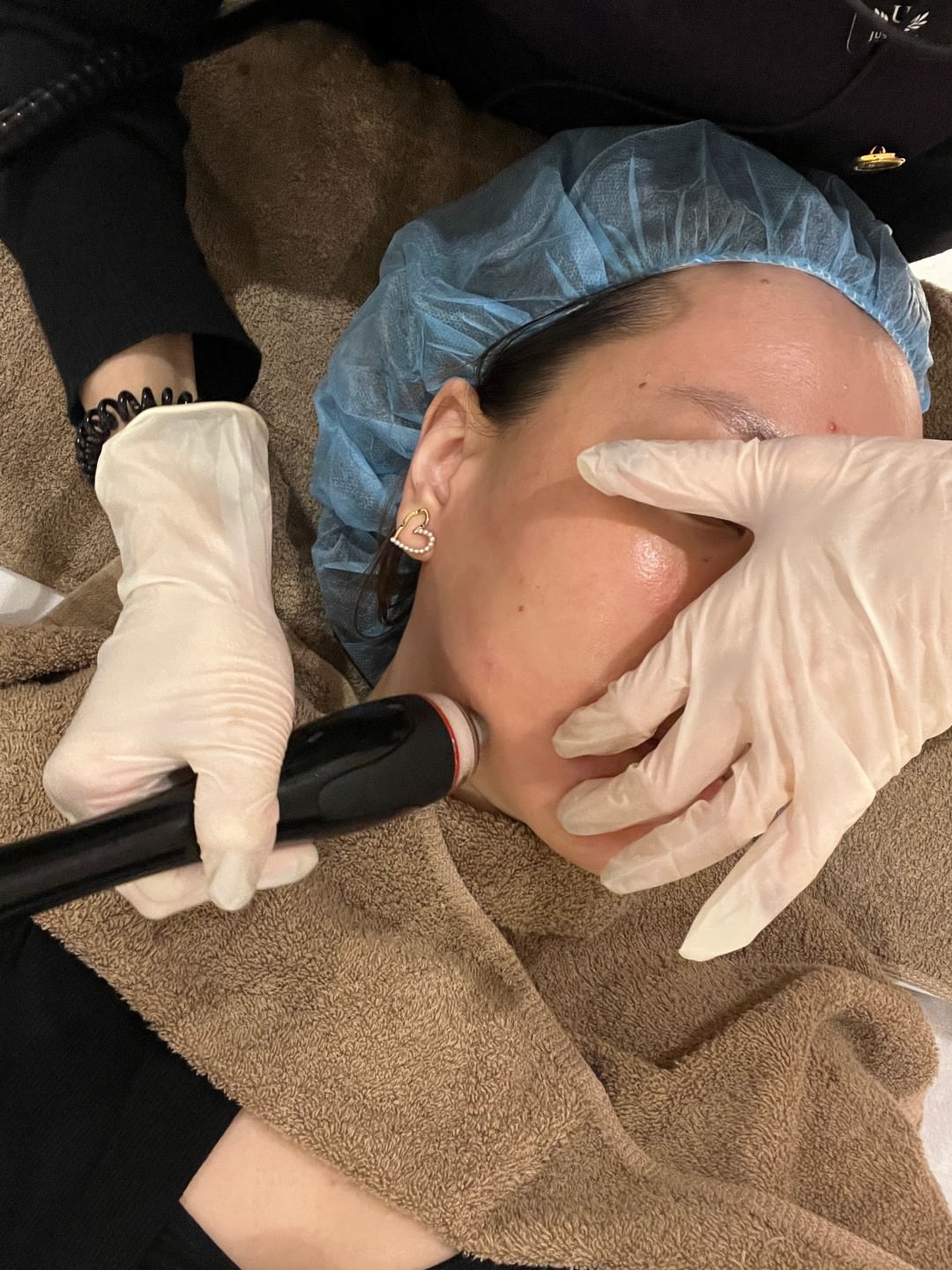 【油痘粉刺肌必看】佳思優整形醫美診所『黑鑽水飛梭』初體驗，粉刺大掃除，肌膚亮出新高度～