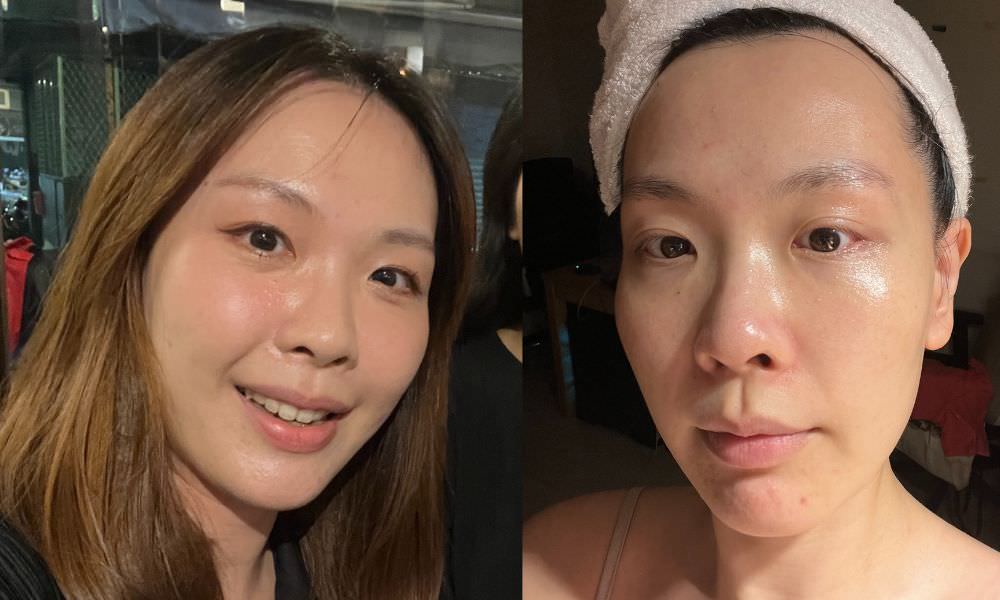 【油痘粉刺肌必看】佳思優整形醫美診所『黑鑽水飛梭』初體驗，粉刺大掃除，肌膚亮出新高度～
