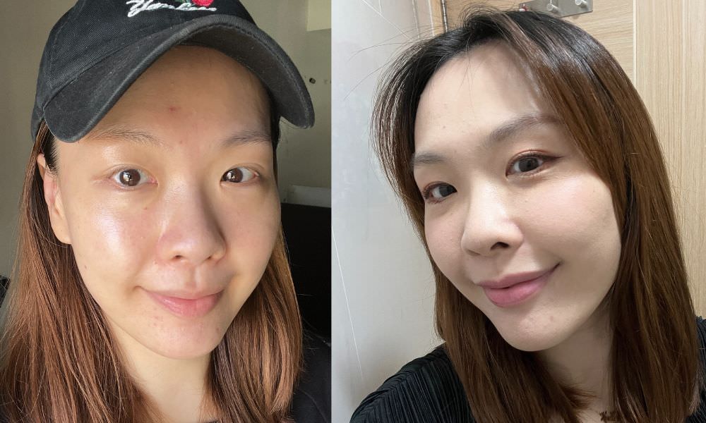 【油痘粉刺肌必看】佳思優整形醫美診所『黑鑽水飛梭』初體驗，粉刺大掃除，肌膚亮出新高度～