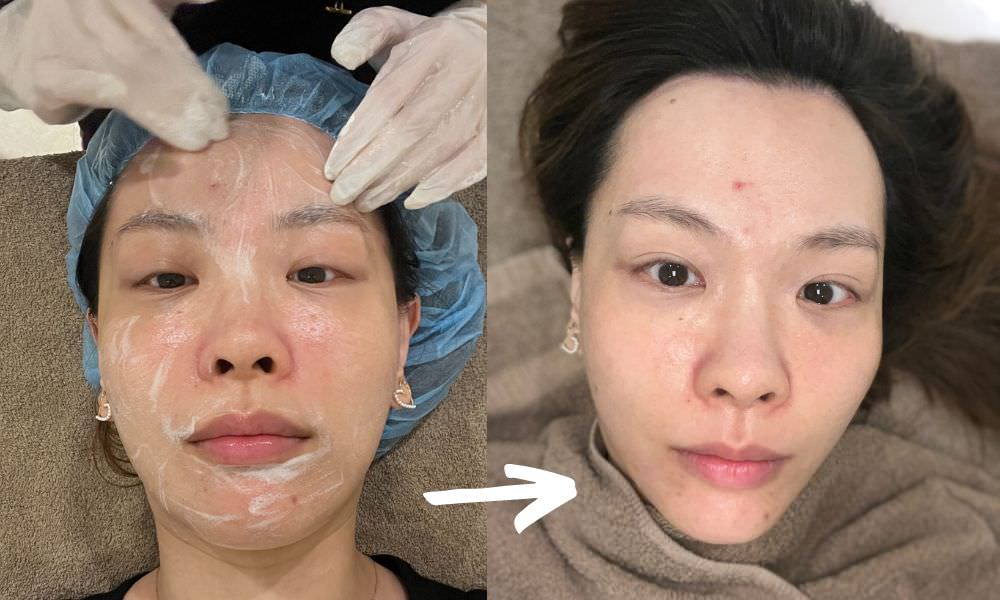 【油痘粉刺肌必看】佳思優整形醫美診所『黑鑽水飛梭』初體驗，粉刺大掃除，肌膚亮出新高度～