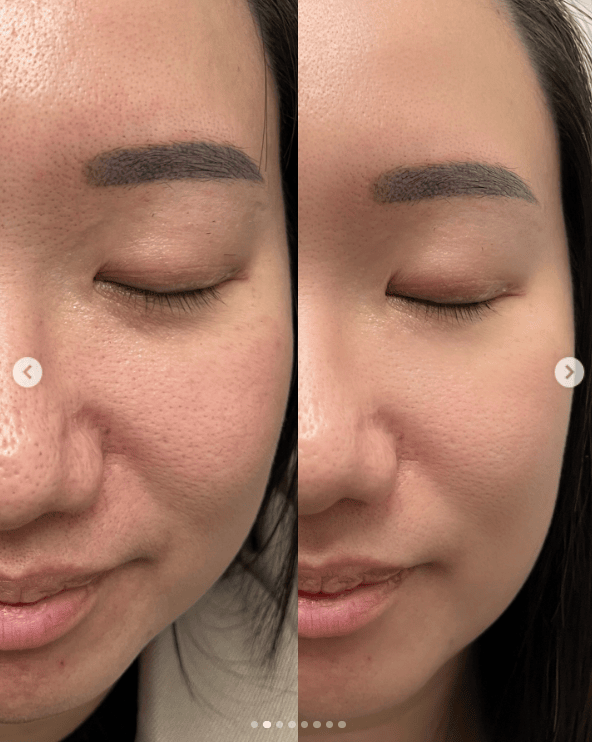 ZIIP HALO 美膚儀實測使用心得～居家美容、出國旅遊必備奈米微電流美膚儀！