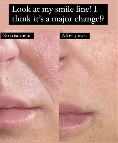 ZIIP HALO 美膚儀實測使用心得～居家美容、出國旅遊必備奈米微電流美膚儀！